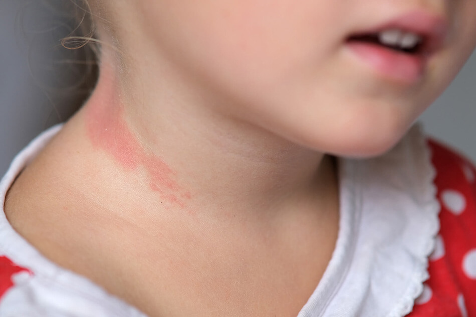 O que é dermatite atópica e o que pode causá-la?